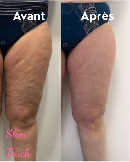 Massage minceur avant après Marie professionnel Amiens